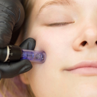 microneedling trebur beauty by mel