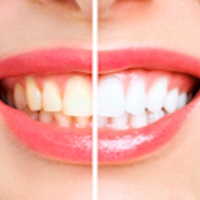 zahnbleaching trebur beauty by mel